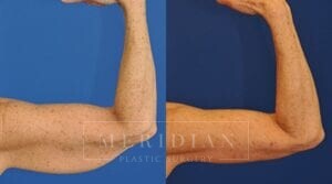 tjelmeland-meridian-austin-body-contouring-patient-16-2