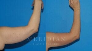 tjelmeland-meridian-austin-body-contouring-patient-19-2