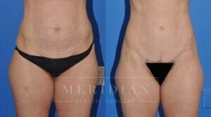 tjelmeland-meridian-austin-body-contouring-patient-2-1