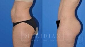 tjelmeland-meridian-austin-body-contouring-patient-2-2