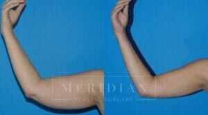 tjelmeland-meridian-austin-body-contouring-patient-20-1