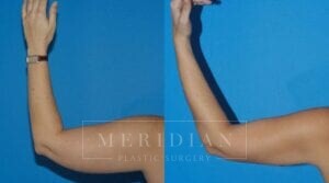 tjelmeland-meridian-austin-body-contouring-patient-20-2