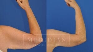 tjelmeland-meridian-austin-body-contouring-patient-21-2