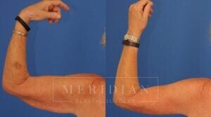 tjelmeland-meridian-austin-body-contouring-patient-22-2