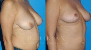 tjelmeland-meridian-austin-body-contouring-patient-23-2