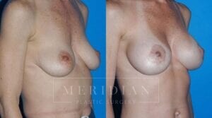 tjelmeland-meridian-austin-body-contouring-patient-24-2