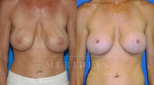 tjelmeland-meridian-austin-body-contouring-patient-25-1