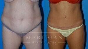 tjelmeland-meridian-austin-body-contouring-patient-4-1