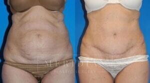 tjelmeland-meridian-austin-body-contouring-patient-5-1