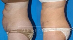 tjelmeland-meridian-austin-body-contouring-patient-5-2