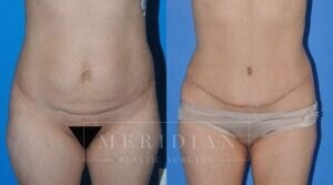 tjelmeland-meridian-austin-body-contouring-patient-7-1