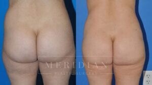 tjelmeland-meridian-austin-body-contouring-patient-7-2