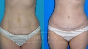 tjelmeland-meridian-austin-body-contouring-patient-8-1