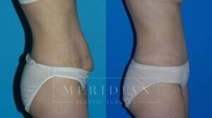 tjelmeland-meridian-austin-body-contouring-patient-8-2