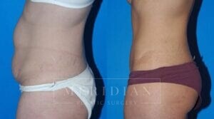 tjelmeland-meridian-austin-body-contouring-patient-9-2