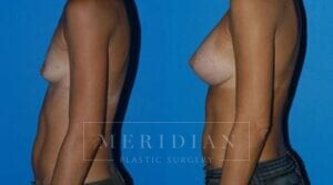 tjelmeland-meridian-austin-breast-augmentation-patient-1-2