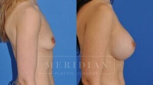 tjelmeland-meridian-austin-breast-augmentation-patient-10-2