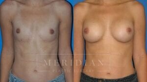 tjelmeland-meridian-austin-breast-augmentation-patient-14-1