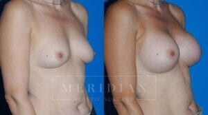 tjelmeland-meridian-austin-breast-augmentation-patient-15-2