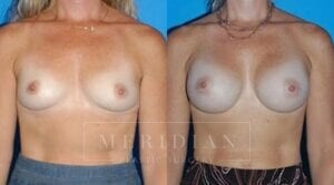 tjelmeland-meridian-austin-breast-augmentation-patient-17-1