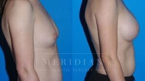 tjelmeland-meridian-austin-breast-augmentation-patient-2-2