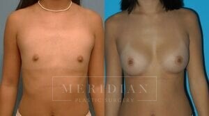 tjelmeland-meridian-austin-breast-augmentation-patient-28-1