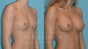 tjelmeland-meridian-austin-breast-augmentation-patient-29-2