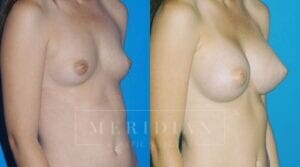 tjelmeland-meridian-austin-breast-augmentation-patient-3-2