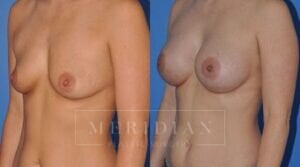 tjelmeland-meridian-austin-breast-augmentation-patient-4-2