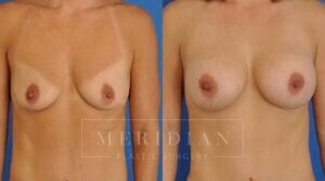 tjelmeland-meridian-austin-breast-augmentation-patient-5-1