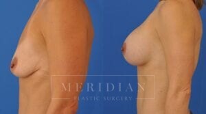 tjelmeland-meridian-austin-breast-augmentation-patient-5-2