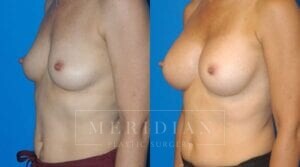 tjelmeland-meridian-austin-breast-augmentation-patient-6-2