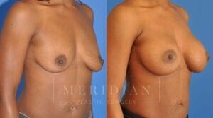 tjelmeland-meridian-austin-breast-augmentation-patient-7-2