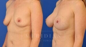 tjelmeland-meridian-austin-breast-augmentation-patient-8-2