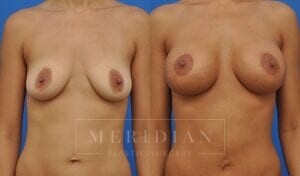 tjelmeland-meridian-austin-breast-lift-patient-1-1