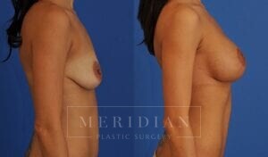 tjelmeland-meridian-austin-breast-lift-patient-1-2