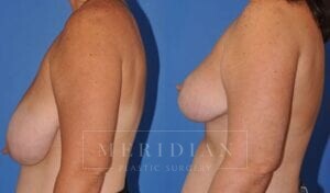 tjelmeland-meridian-austin-breast-lift-patient-10-2