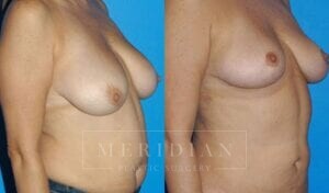 tjelmeland-meridian-austin-breast-lift-patient-2-2