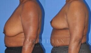 tjelmeland-meridian-austin-breast-lift-patient-3-2