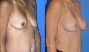 tjelmeland-meridian-austin-breast-lift-patient-4-2