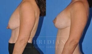 tjelmeland-meridian-austin-breast-lift-patient-5-2