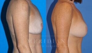 tjelmeland-meridian-austin-breast-lift-patient-6-2