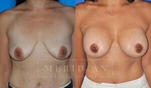 tjelmeland-meridian-austin-breast-lift-patient-7-1