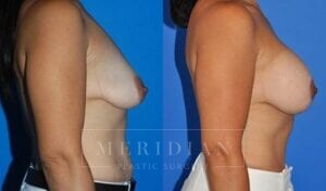 tjelmeland-meridian-austin-breast-lift-patient-7-2