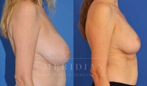 tjelmeland-meridian-austin-breast-lift-patient-9-2