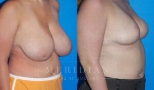 tjelmeland-meridian-austin-breast-reduction-patient-1-2