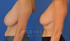 tjelmeland-meridian-austin-breast-reduction-patient-11-2