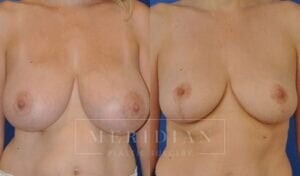 tjelmeland-meridian-austin-breast-reduction-patient-3-1