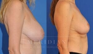 tjelmeland-meridian-austin-breast-reduction-patient-3-2