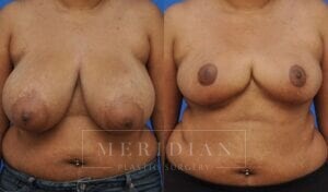 tjelmeland-meridian-austin-breast-reduction-patient-4-1